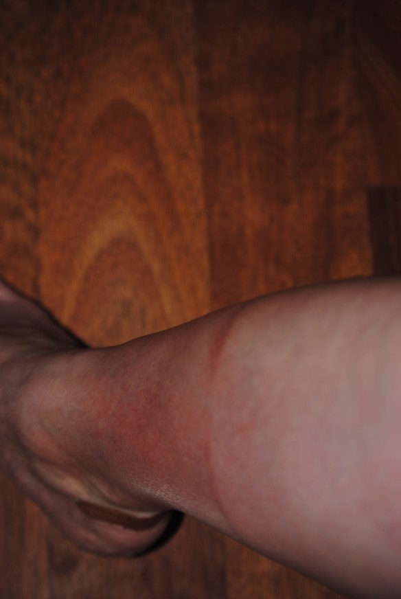 Dumb, dumb, dumb, dumb, dumb. That's my only excuse. The mark has faded, but it still looks like I left a pair of too tight socks on. Nice one, Val. Nice one.