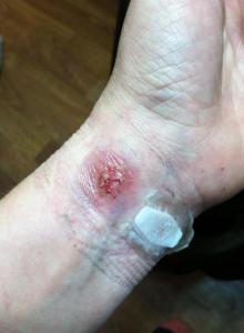 The doc sliced an "X" in the wound to get it to drain...and although I have a scar still, I'm grateful for how well it healed now.